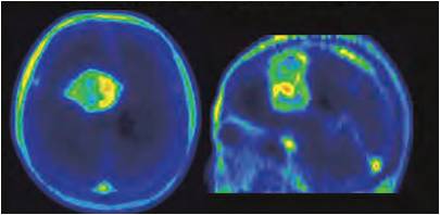神経膠芽腫のアクアポリン4PET分子イメージング