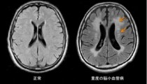 脳小血管病の新たな発症メカニズムを解明