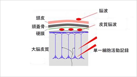 脳の表面から単一細胞活動記録より低侵襲的に、脳波より高感度で神経活動を記録する、皮質脳波法のスキーマ