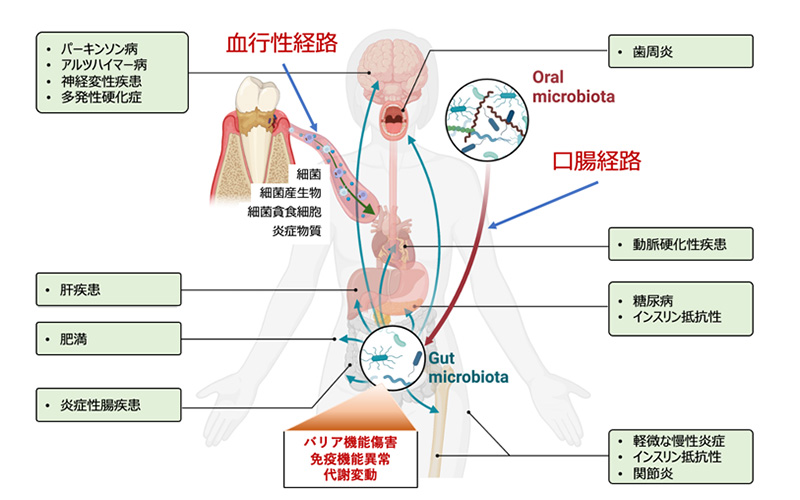 歯周病が全身疾患に影響を与える因果メカニズムの図
